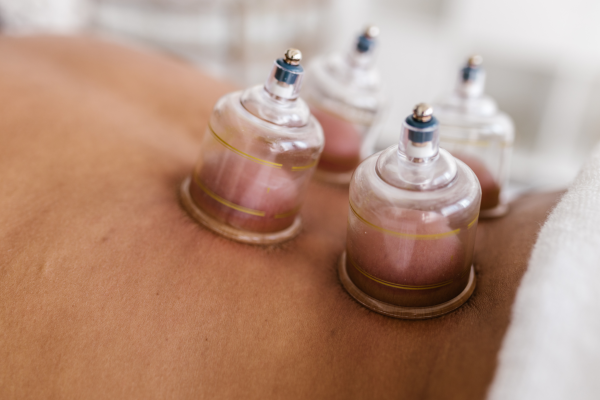 Chiropractic care Cupping and chiropractor