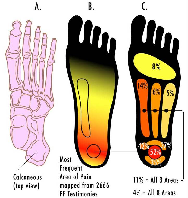 Diagram of the sole of the foot showing where plantar fasciitis heel and arch pain is felt